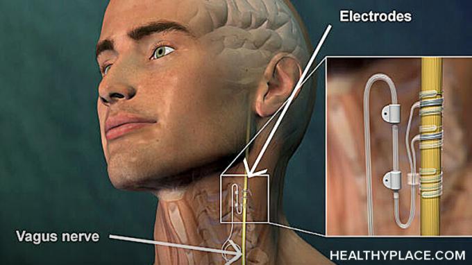 La stimulation du nerf vague est destinée à la dépression résistante au traitement. Renseignez-vous sur la thérapie VNS, les effets secondaires de la stimulation du nerf vague et le coût.