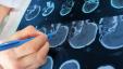 Les scanners cérébraux 3D peuvent augmenter la précision du diagnostic du TDAH