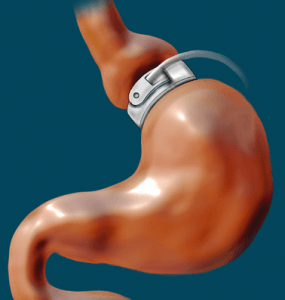 Lap-Band est un exemple d'un type de chirurgie gastrique qui peut être utilisé pour traiter les troubles de la boulimie.